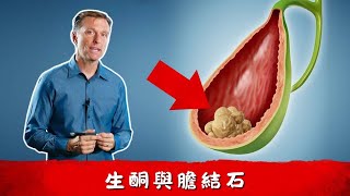 膽結石原因!!吃多脂肪會膽結石嗎？高膽固醇原因,自然療法,柏格醫生 Dr Berg