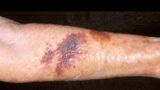 Actinic (Senile) Purpura Treatment, How to Prevent