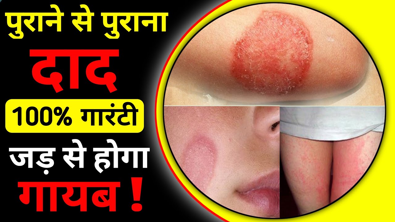 Derma KT Cream derma-kt-cream