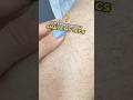 My Honest Lazer Hair Removal Journey Lazer Hairremoval Razer Hairregrowth Hairremovalforwomen