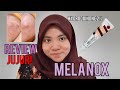 [SALEP JERAWAT MELANOX] Rawat Jerawat Membandel dengan Aman dan Efektif