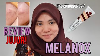 REVIEW JUJUR ! SALEP MELANOX BENERAN BISA NGURANGIN BEKAS JERAWAT || MENGHILANGKAN BEKAS JERAWAT