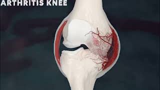 Genicular Artery Embolization gae