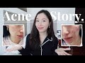 How to get rid of acne | Skincare routine that WORKS.