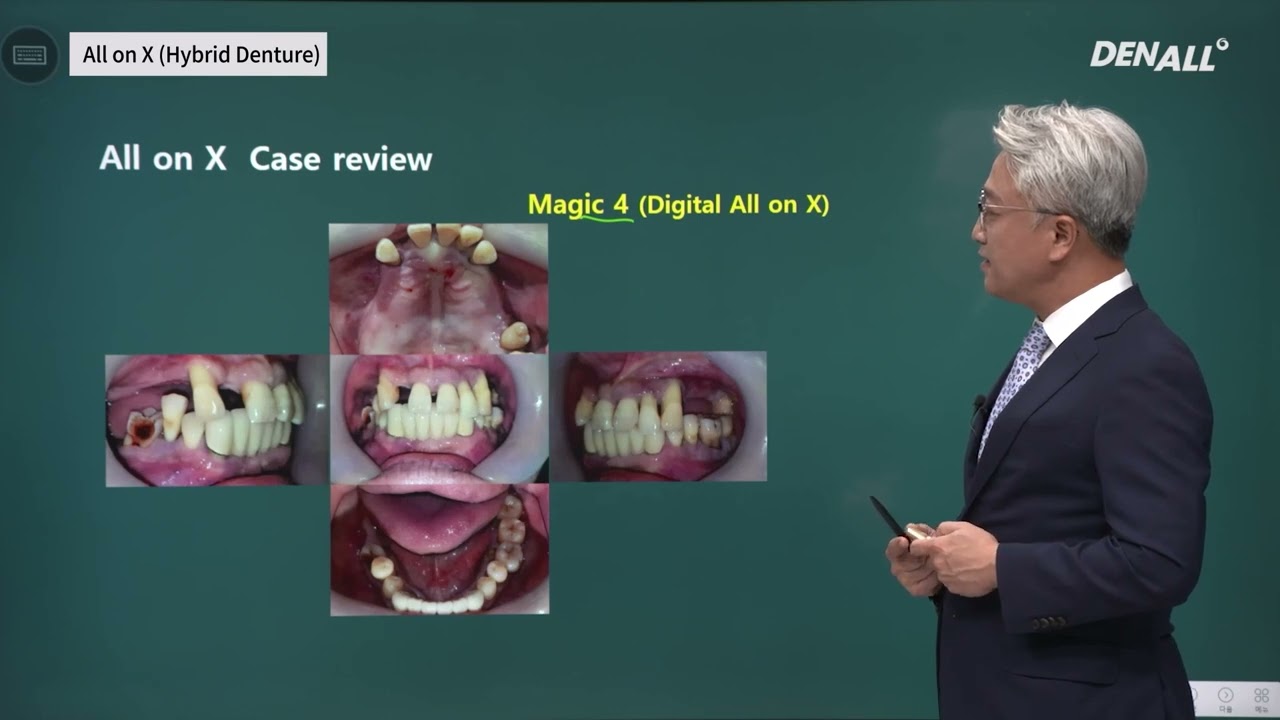 [ПРОТЕЗИРОВАНИЕ] Гибридный протез All on X