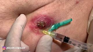 BLACKHEAD Revenge Part 1B, the Ruptured cyst from Hell