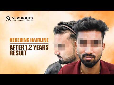 LOOK at His Hairline Before vs After! 😲 | 1000 Grafts | Hair Transplant in Bangalore | Best Cost