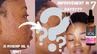 #MyAcneJourney:100% Cold Pressed SOIL Rosehip Oil for 7 days, they said it will work, Did it?