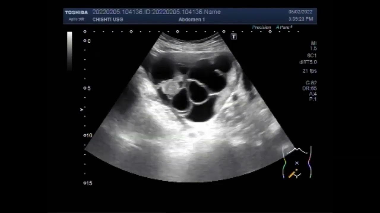 Septated ovarian cysts youtube