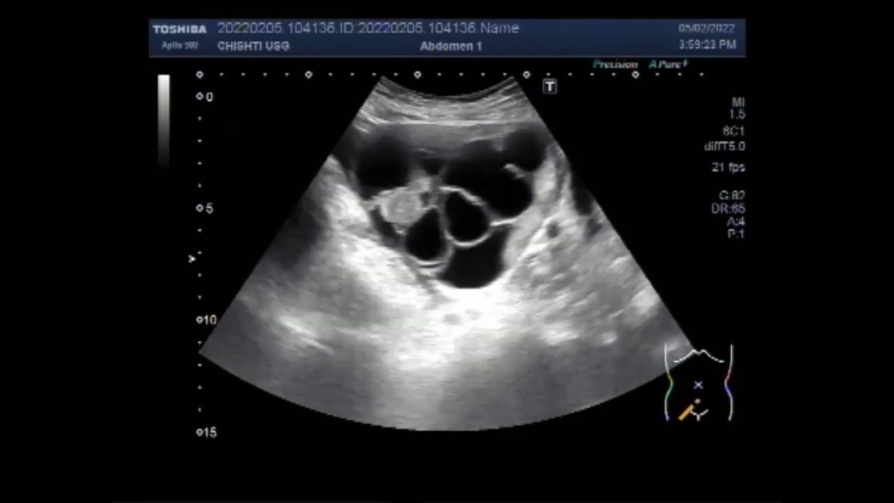 Septated Ovarian Cysts YouTube Septated Ovarian Cysts YouTube