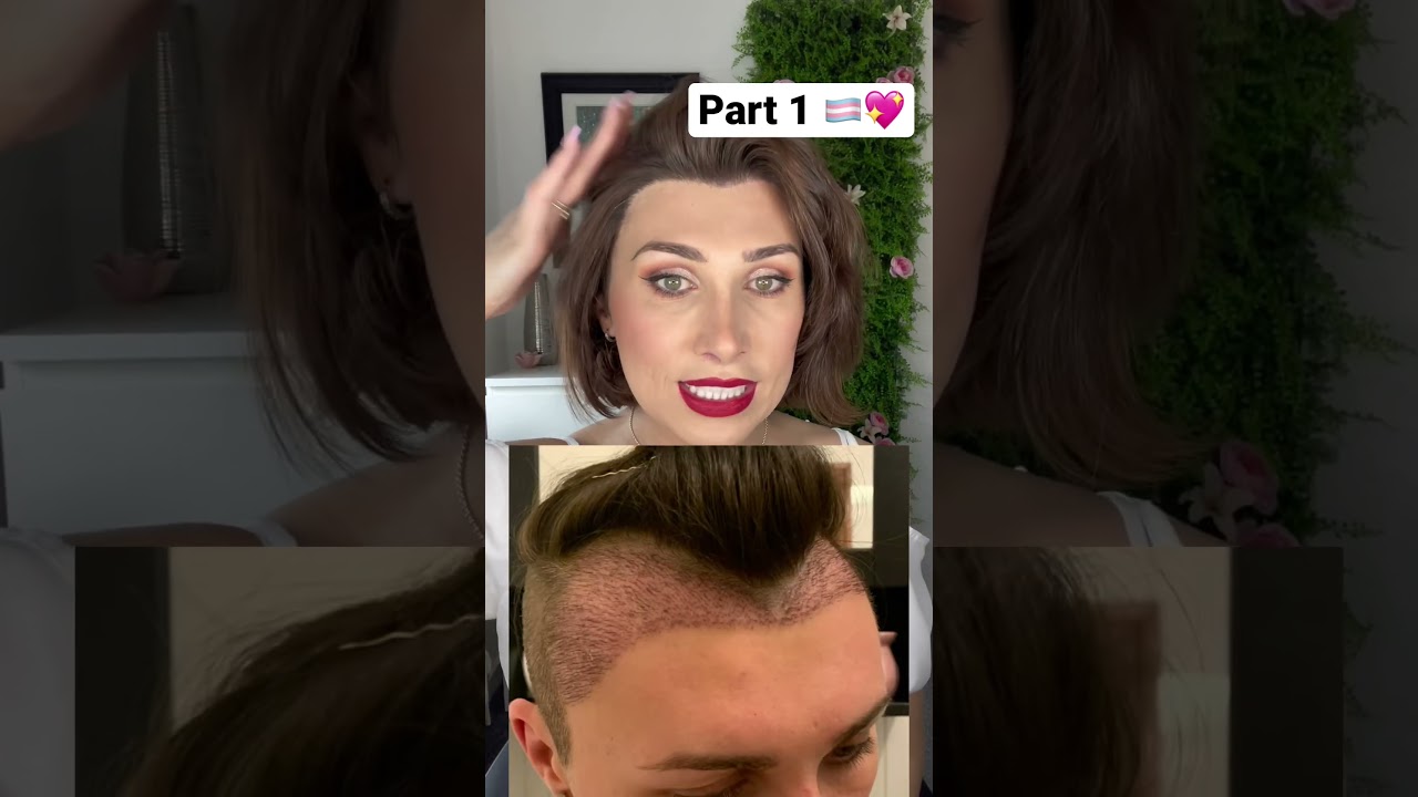 My Hair Transplant (Male to Female) part 1 