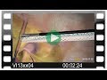 Dynameshendolap 3d  animation tapp technique for treatment of inguinal hernia