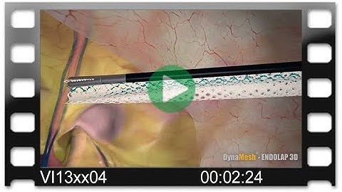 DynaMesh®-ENDOLAP 3D - Animation: TAPP Technique for Treatment of Inguinal Hernia