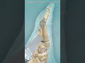Bunion correction surgery #sad #science #aestheic