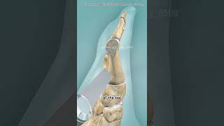 Bunion correction surgery #sad #science #aestheic