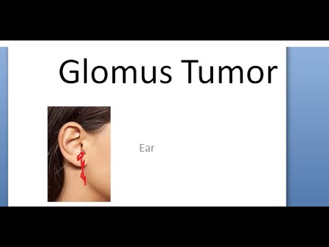 ENT Glomus Tumor Jugulare Tympanicum Ear Middle Bodies Rising Sun Brown Sign Pulsating Treatment