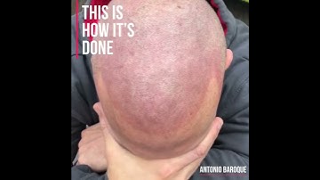 Scalp Micropigmentation by Antonio Baroque