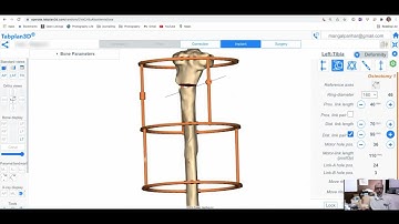Revision Surgery Planned by Dr Mangal Parihar in 3D using Tabplan3D   Fixation by Ilizarov Fixator