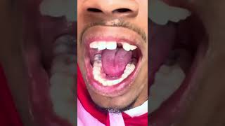 From Toothless to Hollywood Smile! 🦷✨ Chrisean Rock Helped Me