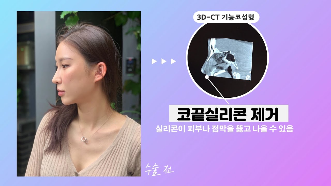 [Эйтоп гоо сайхны мэс заслын эмнэлэг] "Силикон арьс эсвэл салст бүрхүүлээс нэвтэрч гарч ирж болно" 💜Хамрын дахин мэс заслын селфи сэтгэгдэл/Эйтоп гоо сайхны мэс заслын эмнэлэг/ATOP plastic surgery/韩国爱她整形外科医院