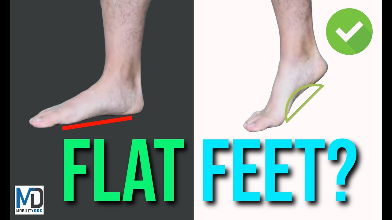 Flexible vs Rigid Flat Feet: Know the Difference