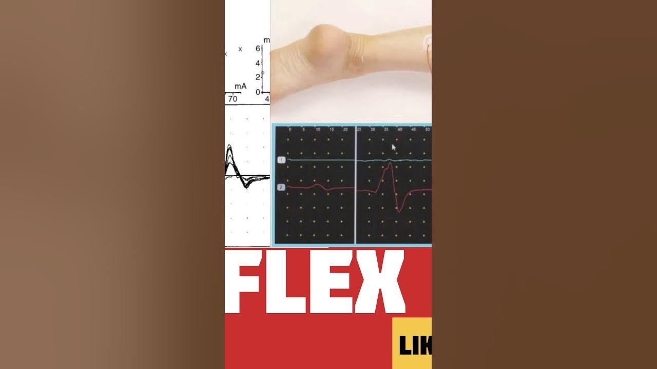 H reflex test tutorial The_healers YouTube