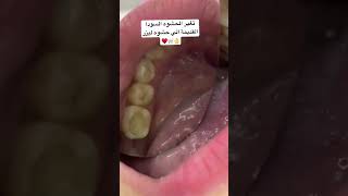 تغير الحشوه السودا القديمة الي حشوه ليزر تجميلي #toothpaste #اكسبلور #toothrestoration #explore #