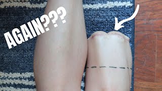 My Leg Is Getting AMPUTATED AGAIN!? 😮 Getting the same leg cut off twice....