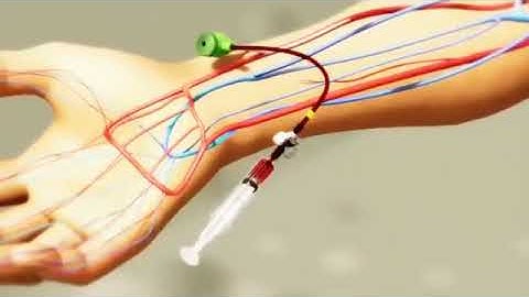 Radial artery puncture using the 