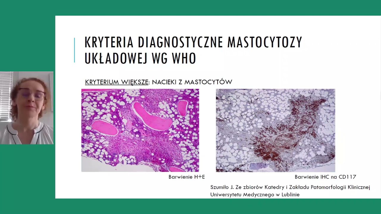 Mastocytoza – rozpoznawalność, symptomy i diagnostyka