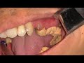 TARTAR KARANG GIGI | Dentist | Dokter Gigi Tri Putra