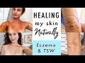 How I CURED Eczema & Topical Steroid Withdrawal NATURALLY | My Skin Healing Journey