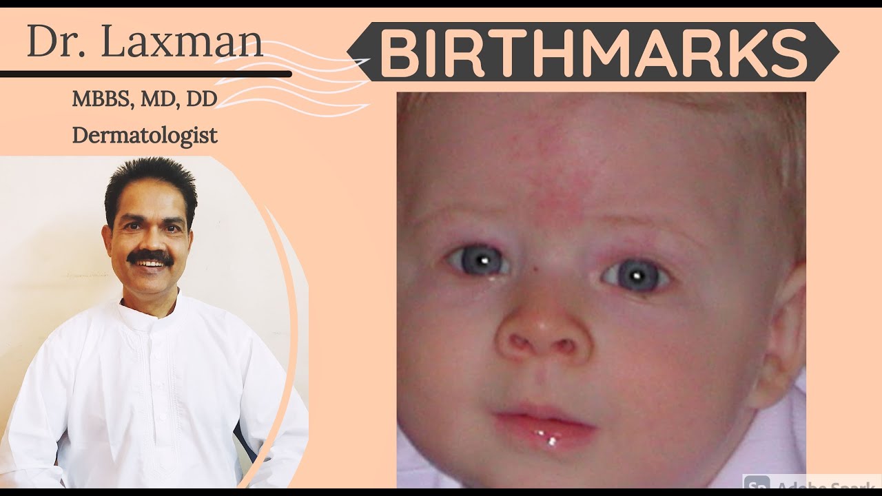 Birthmarks | Birthmark- 1 | Types Of Birthmarks | Strawberry Hemangioma | Hemangioma | Salmon Patch
