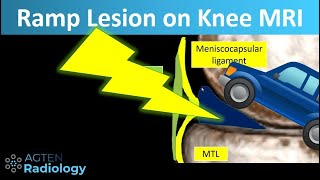 Ramp lesions on knee MRI (part 2)