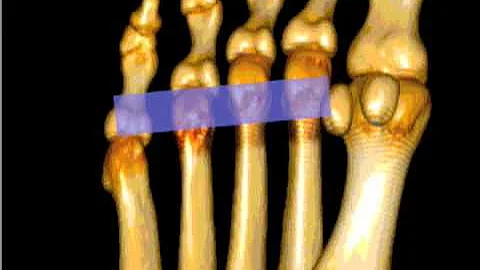 How To: Morton's Neuroma Case Study Video