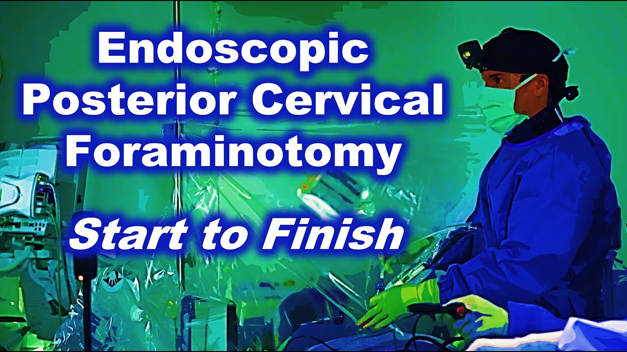 Endoscopic Spine Surgery Start to Finish Posterior Cervical