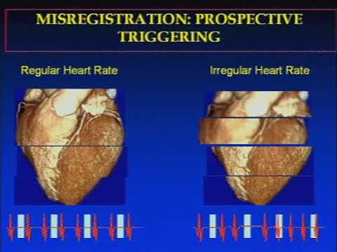 The Basics of Coronary CT Angiography