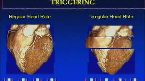 The Basics of Coronary CT Angiography