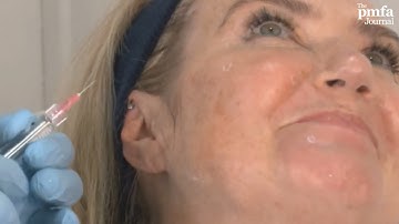 Dalvi Humzah demonstrates the five bio-aesthetic point (BAP) injection technique using Profhilo®.