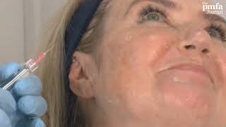 Dalvi Humzah demonstrates the five bio-aesthetic point (BAP) injection technique using Profhilo®.