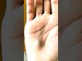 A Man NOTICED A BLACK LUMP On His Palm And Rushed To The HOSPITAL What Was REVEALED Is UNTHINKABLE 
