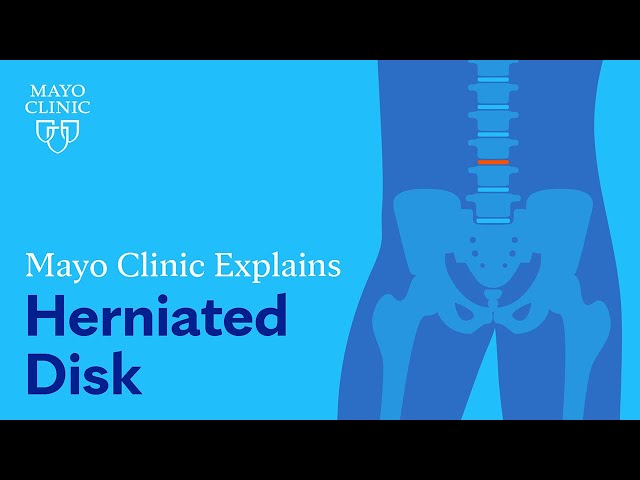 Spinal stenosis - Symptoms and causes - Mayo Clinic