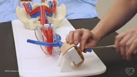 Alternative Strategies for Challenges in Veno Arterial ECMO Cannulation 03 1