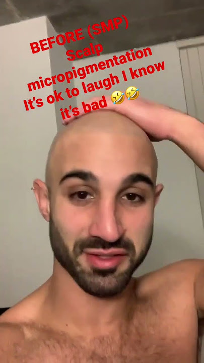 Before & After Scalp Micropigmentation (SMP)