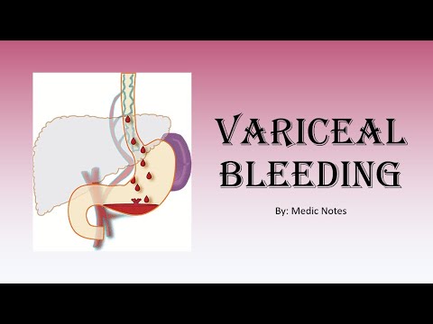 Variceal bleeding / ruptured esophageal varices