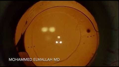 TORIC IOL left in the sulcus.... Repositioning an Intraocular Lens