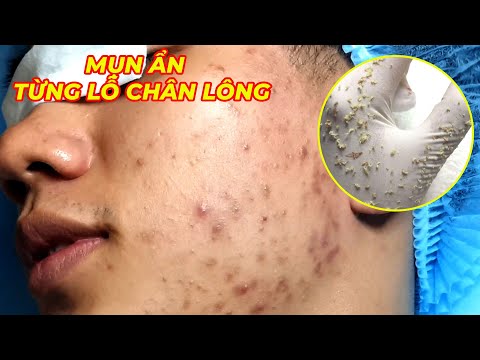 Video Điều trị mụn hiệu quả số 1 TPHCM | Phòng khám da liễu... - youtube