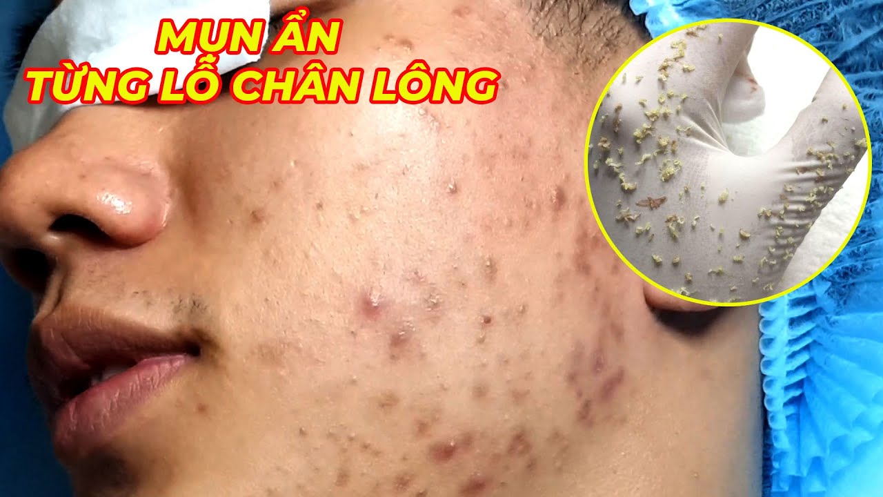 Điều trị mụn hiệu quả số 1 TPHCM | Phòng khám da liễu HHV Clinic |Hiền Vân spa | Đỗ Thu Hiền | 722