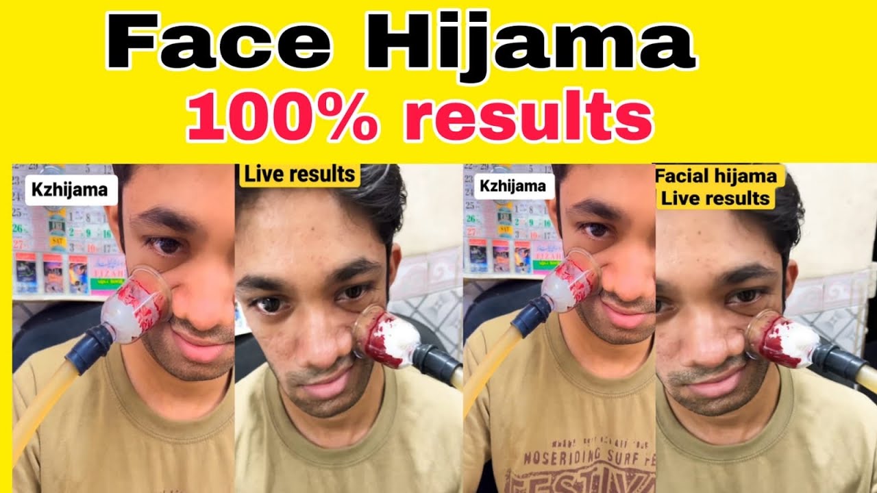 Is Hijama good for face? What are the benefits of facial cupping?