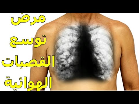 توسع القصبات | حالة مزمنة وخطيرة | هل تعاني من أعراضها